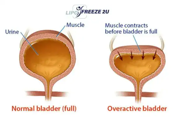 diagram of overactive bladder treatment Bishop's Stortford