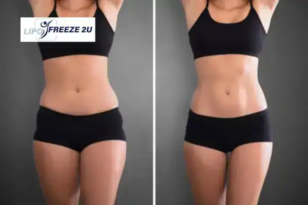 How Can LIPO FREEZE 2U Support Your Post-Pregnancy Body Recovery Bishop's Stortford?