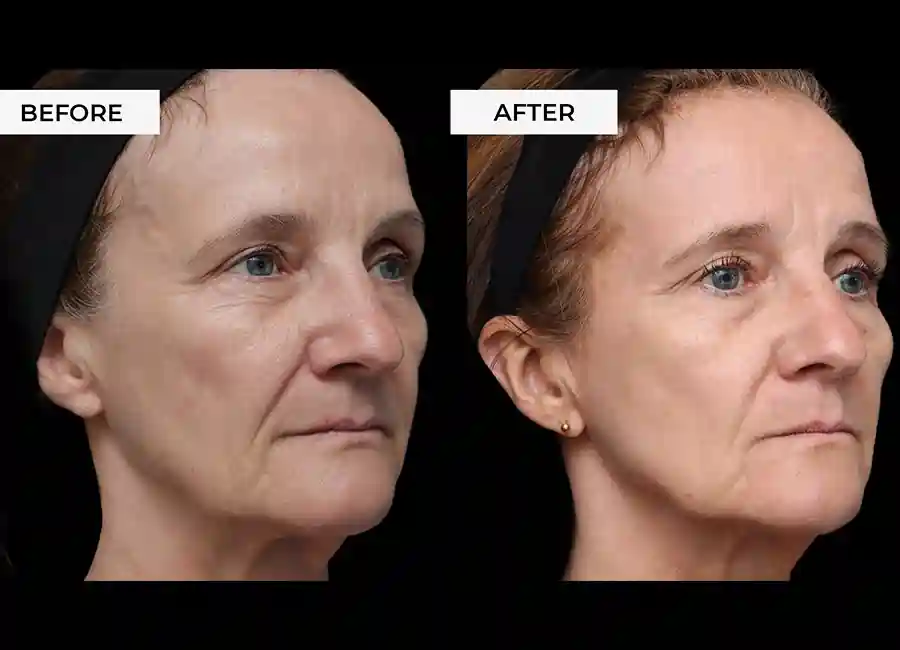 How Many RF Microneedling Sessions Will You Need to See a Difference Bishop's Stortford?