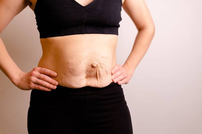 Is Surgery Really the Only Way to Repair Diastasis Recti Bishop's Stortford?